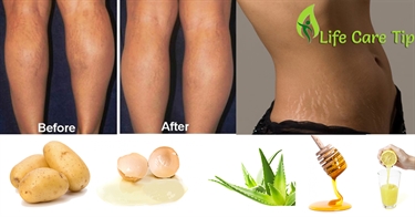 How To Get Rid Of Scars And Stretch Marks