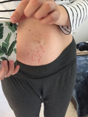 Stretch Marks After Breast Augmentation 3 Months Post