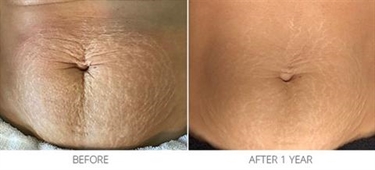 Stretch Marks On Your Butt