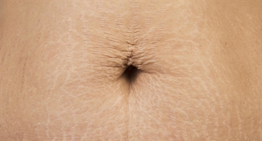 Where To Get Stretch Marks Removed