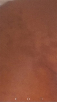 What To Use For Breast Stretch Marks