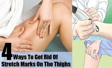 Shoulder Stretch Marks Removal