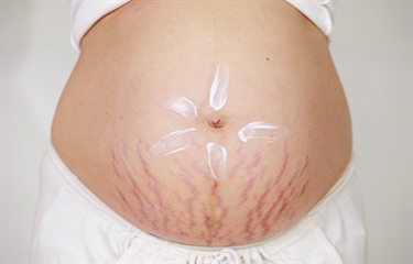 Stretch Marks In Puberty