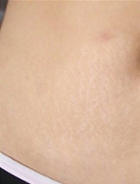How To Fade Stretch Marks In A Week