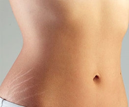 Stretch Marks Fixed During Breast Lift
