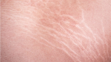 How To Get Rid Of Scars On Legs