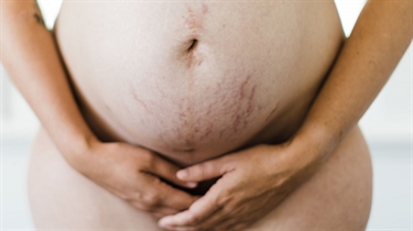 How To Get Rid Of Old Stretch Marks Fast