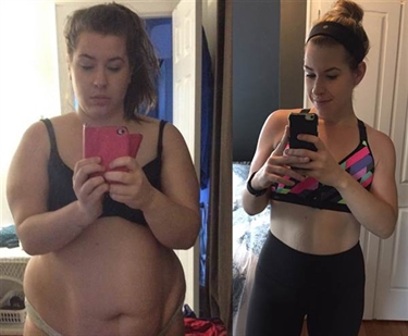 Stretch Marks No Weight Gain