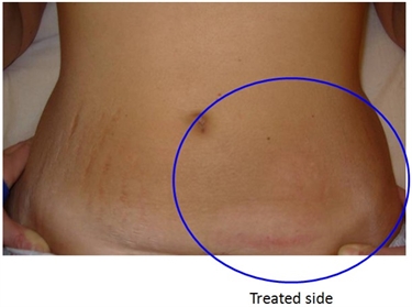 Weight Gain Stretch Marks