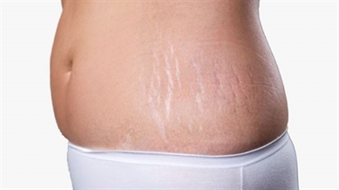 Difference Between Stretch Marks And Breast Cancer