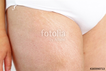 Will Scar Cream Work On Stretch Marks