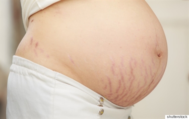 Stretch Marks On Teenager
