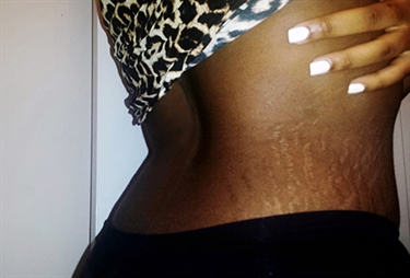 How To Get Rid Of Baby Stretch Marks