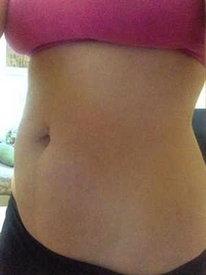 Fraxel Laser For Stretch Marks On Breasts