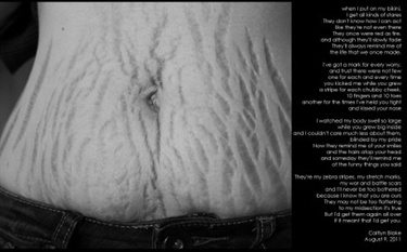 What Helps Diminish Stretch Marks On Breasts