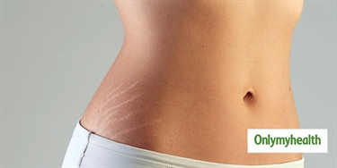 How To Effectively Get Rid Of Stretch Marks
