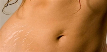 Stretch Marks Workout