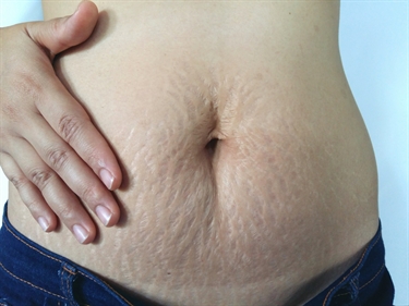 How To Get Stretch Marks Removed