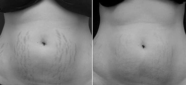 Growth Spurt Stretch Marks