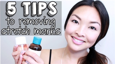 How To Avoid Stretch Marks Working Out