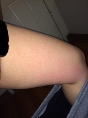 What Can Make Stretch Marks Go Away