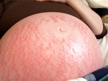 If You Lose Weight Will Your Stretch Marks Go Away