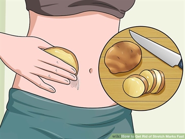 Get Rid Of Purple Stretch Marks
