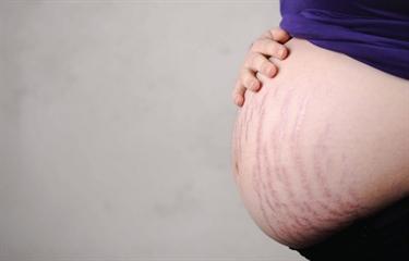 Hiding Stretch Marks