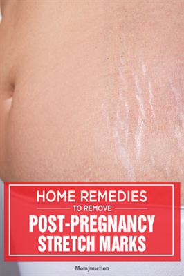 How To Help Stretch Marks During Pregnancy