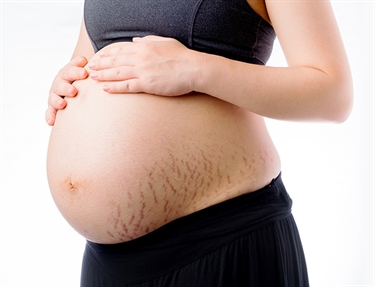 Rid Stretch Marks On Breasts