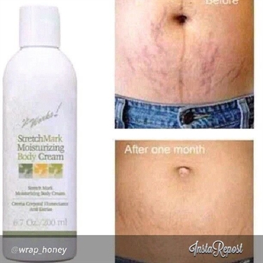 Stretch Marks Types