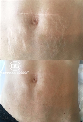 New Stretch Marks On Breast Perimenopause
