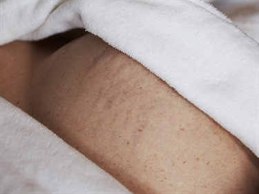 Horrible Pregnancy Stretch Marks