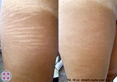 Large Stretch Marks
