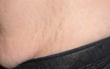 What Does It Mean When You Have Stretch Marks On Your Breast