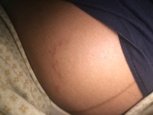 Getting Rid Of Stretch Marks After Weight Loss