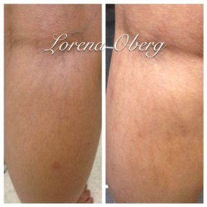 More Stretch Marks On One Breast