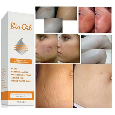 How To Get Away Stretch Marks