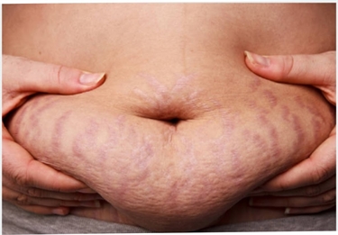 Stretch Mark On Butt