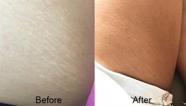 Get Rid Of Stretch Marks On The Breast