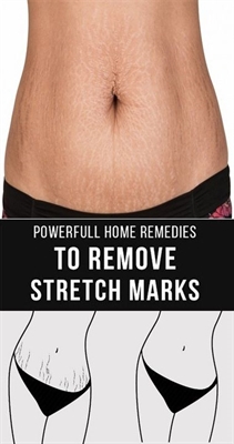 How To Get Rid Of Stretch Marks On Your Stomach
