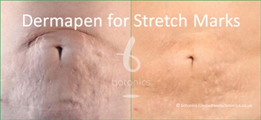 Tanning Stretch Marks Before And After