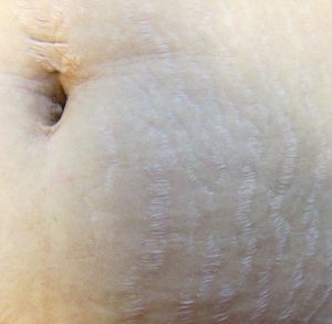 Upper Arm Stretch Marks