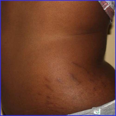 Why Do I Have So Many Stretch Marks