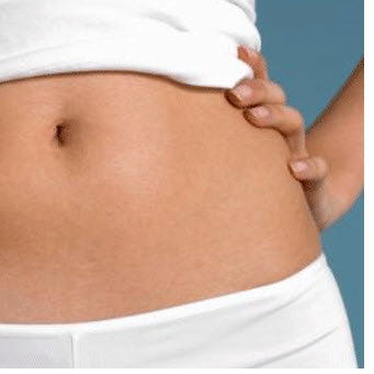 Stretch Marks When Losing Weight