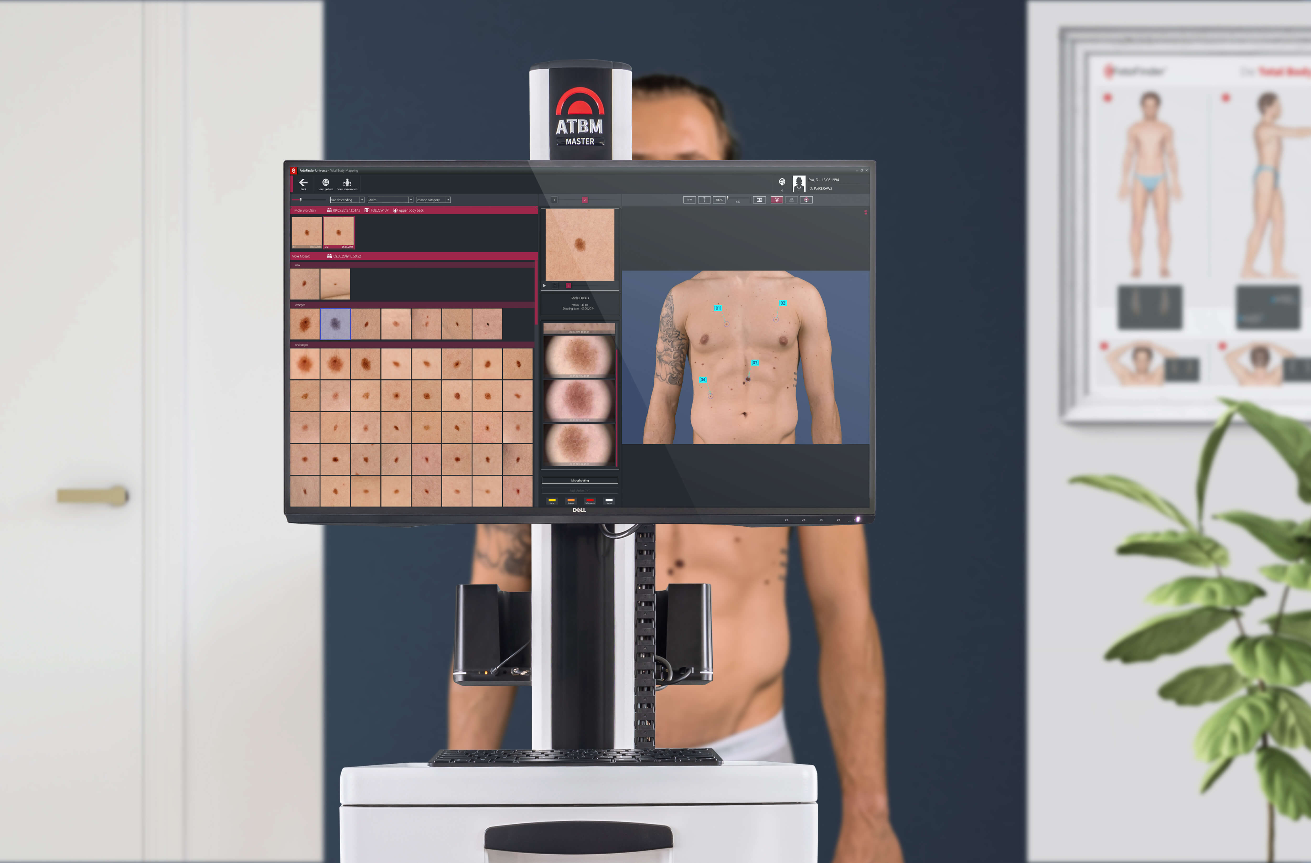 Male patient during mole mapping assessment