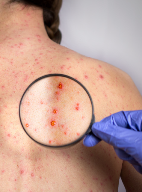 Drug-Induced Skin Reactions in Urgent Care