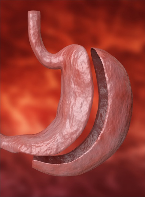 Urgent Care Management of the Patient With Prior Bariatric Surgery
