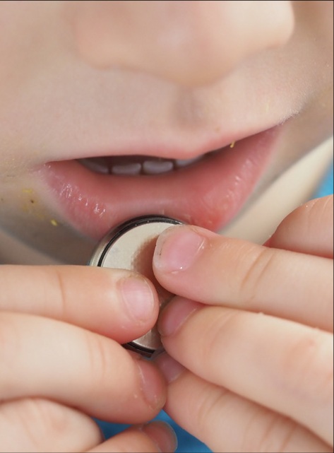 Foreign Body Ingestions in Pediatric Patients: Management in the Emergency Department