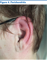Figure 4. Perichondritis